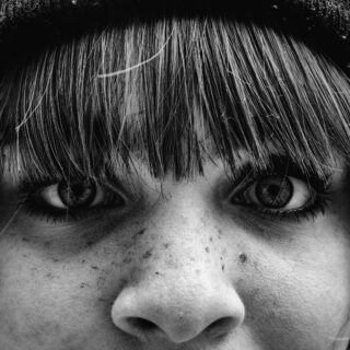 Akne Akne – Ursachen, Symptome und Behandlung