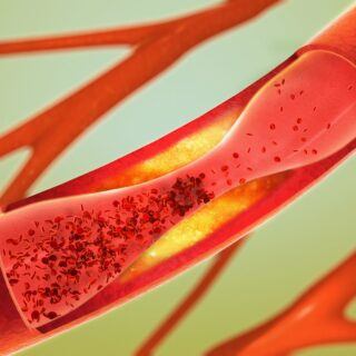 Arteriosklerose Arteriosklerose - Ursachen, Symptome und Behandlung