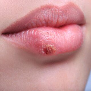 Lippenherpes – Ursachen, Symptome und Behandlung