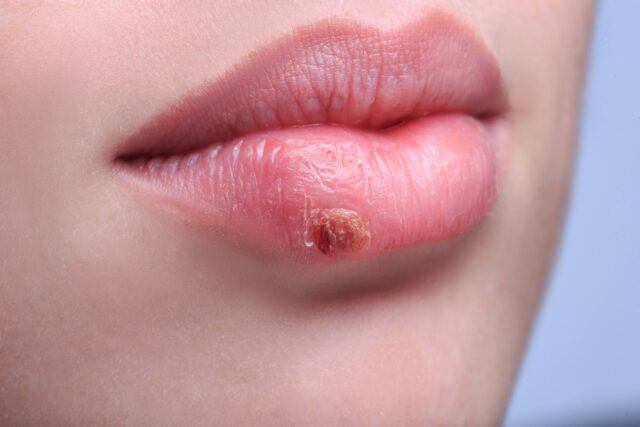 Lippenherpes – Ursachen, Symptome und Behandlung