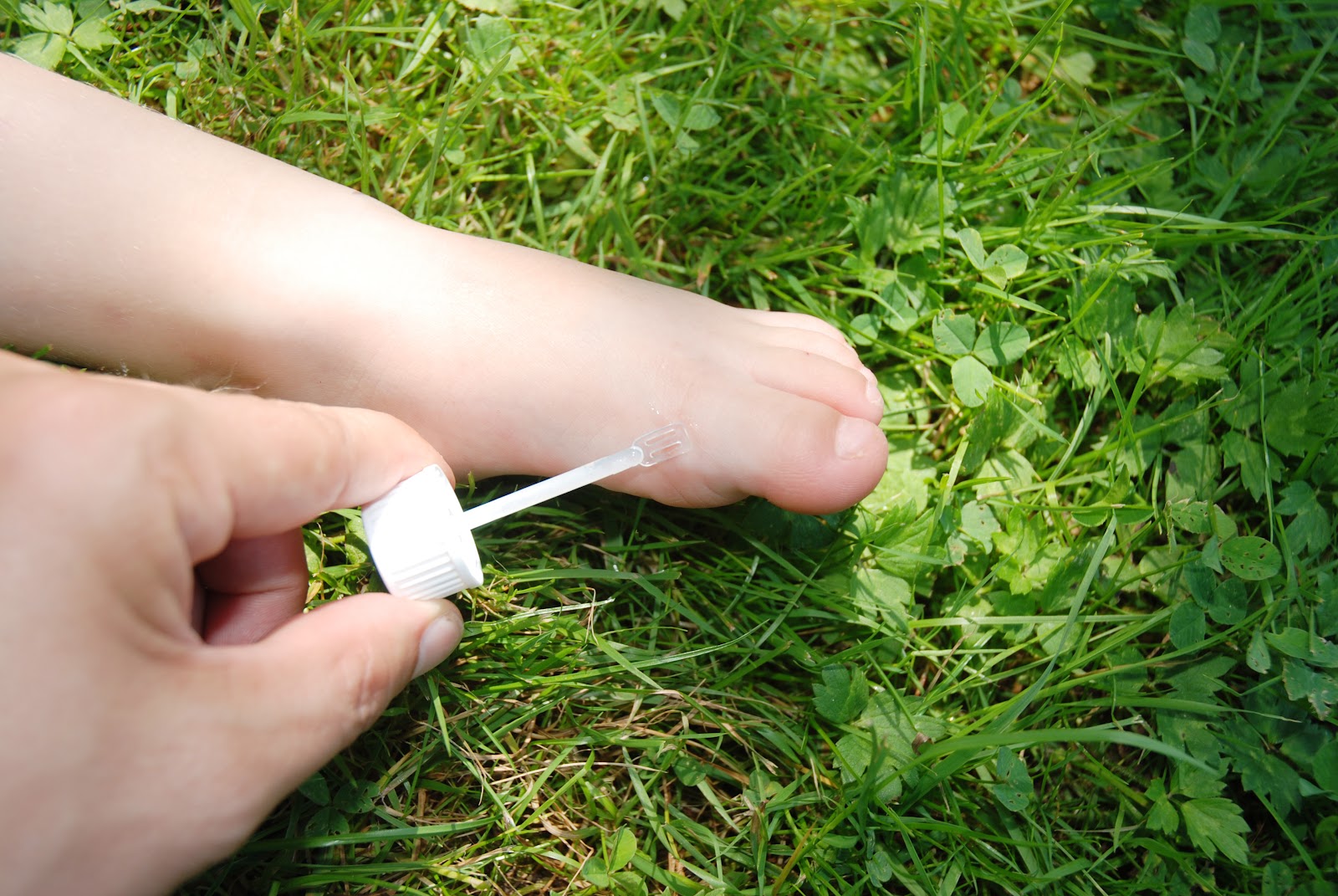 Warzen – Ursachen, Symptome und Behandlung