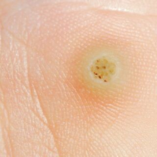 Warzen – Ursachen, Symptome und Behandlung