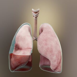 Pleuraerguss Pleuraerguss – Ursachen, Symptome und Behandlung